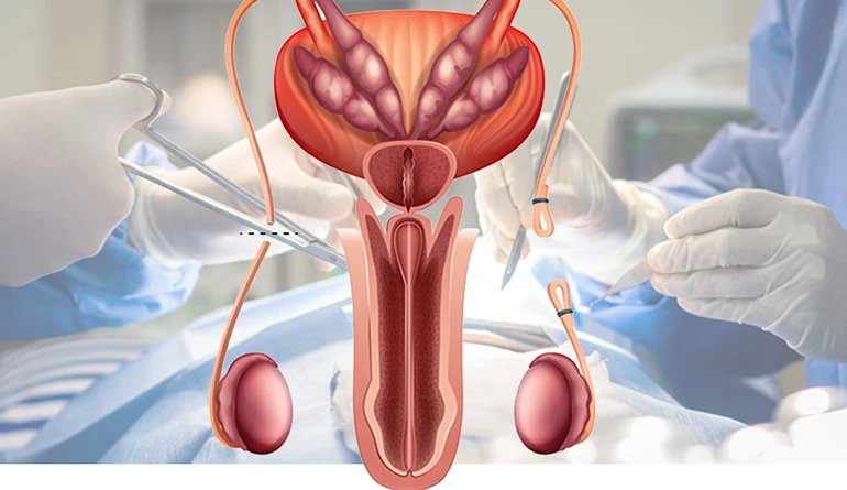 Imagem da cirurgia Vasectomia