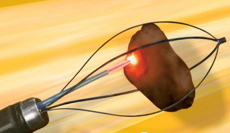 Ícone do tratamento de Cirurgia Endoscópica a Laser