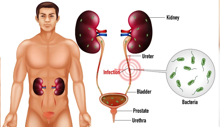 Imagem do tratamento Infecção urinaria