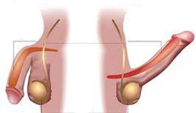 Imagem do tratamento Priapismo