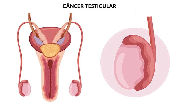 Imagem do tratamento Câncer de testículo