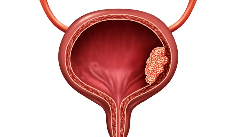 Imagem do tratamento Câncer de bexiga